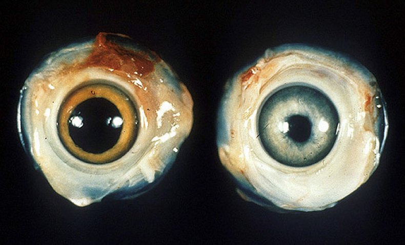 Слева - нормальный куриный глаз. Справа - глаз курицы больной болезнью Марека