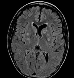 Криптоккоз мозга на МРТ