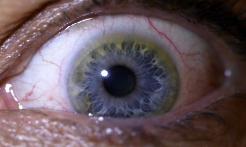 Изменение цвета глаз при отравлении медным купоросом